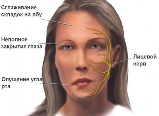 Ce este myasthenia gravis?