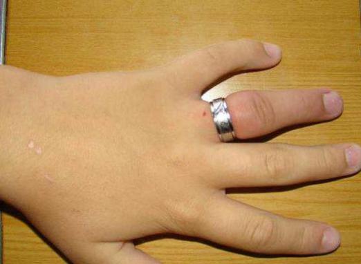 Umflarea degetului: cum să îndepărtați inelul?